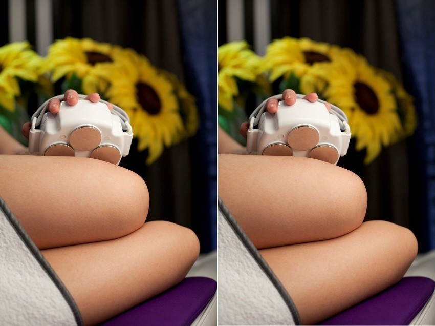 3D lipo tretman za mršavljenje, gubljenje celulita i zaglađivanje kože u studiju Adam&Eva Petrinjska